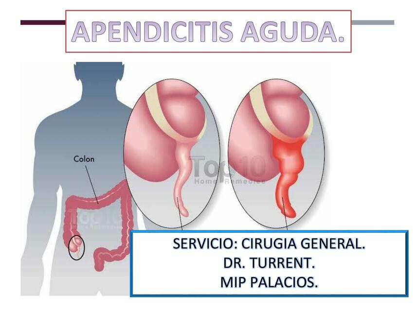 Apendicitis aguda