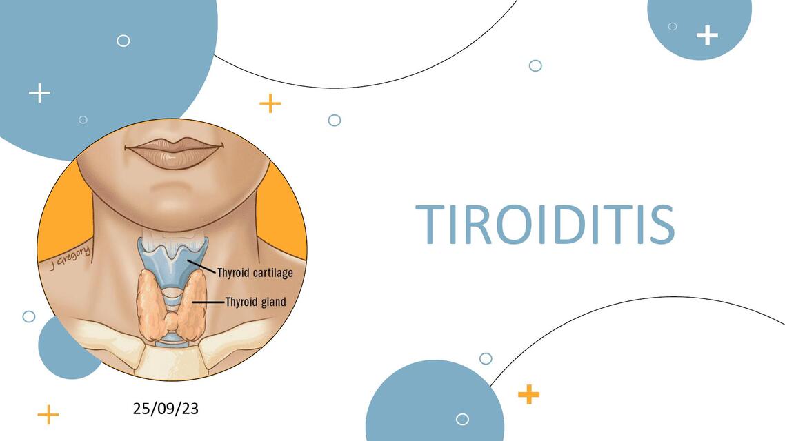 Tiroiditis Tiroiditis | Paola Bandala | uDocz
