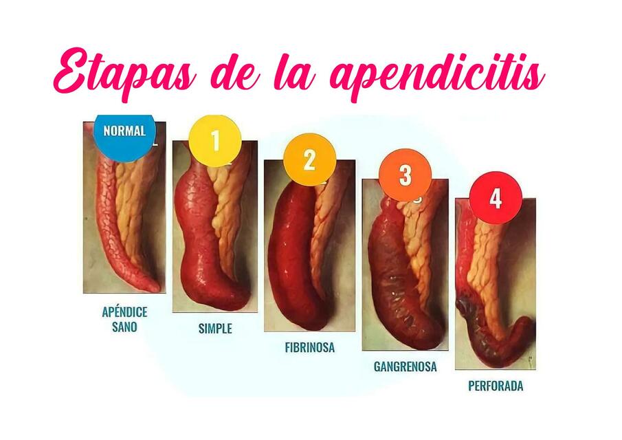 Etapas De La Apendicitis Micaela Pillajo UDocz