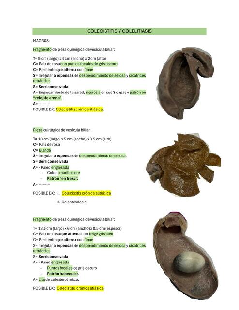 Colecistitis y colelitiasis