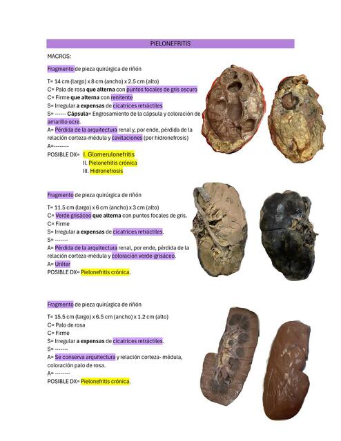 PIELONEFRITIS