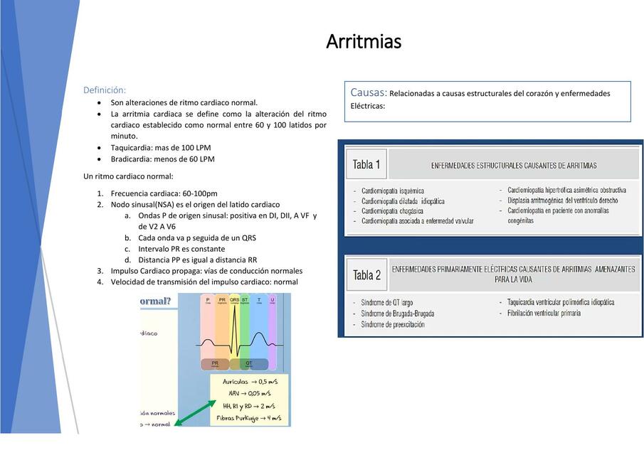 Arritmias