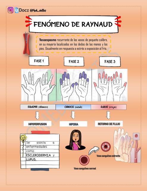 FENÓMENO RAYNAUD - RESUMEN 