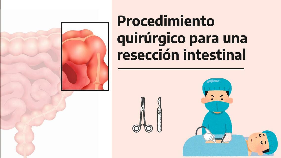 Procedimiento quirúrgico para una resección intestinal