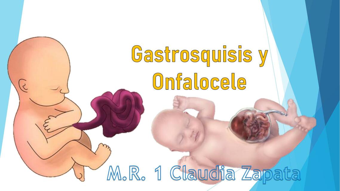 Gastrosquisis y Onfalocele