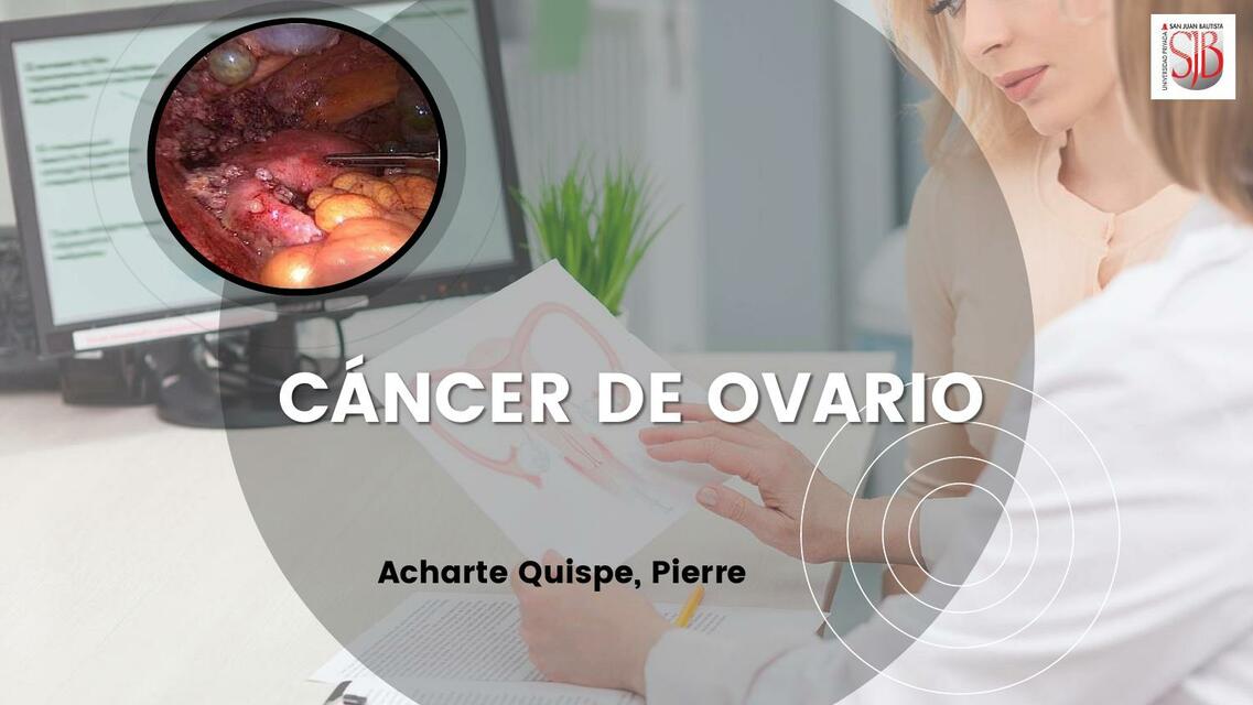 Cáncer de ovario 