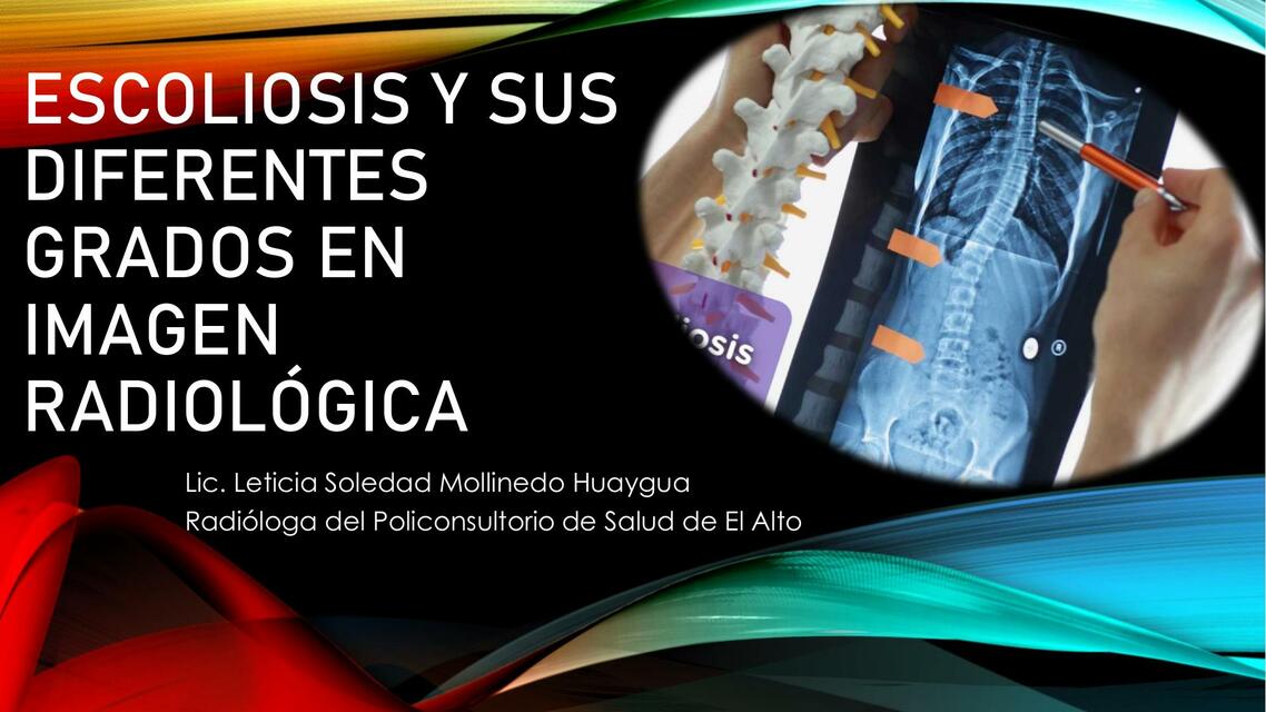 Escoliosis y sus diferentes grados en imagen radiologia