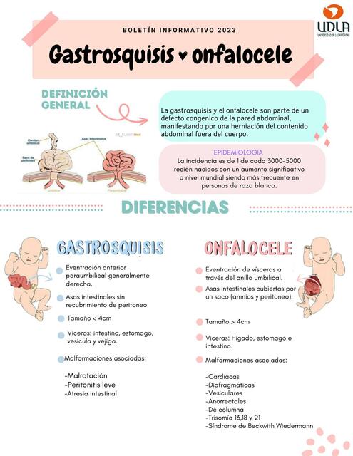 Gastrosquisis Onfalocele