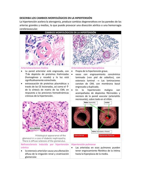 Hipertensión y vasculitis