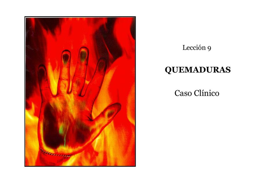 Quemaduras- Caso Clínico