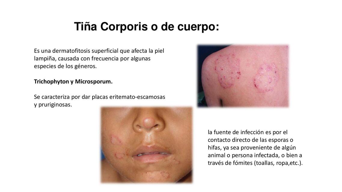 Tiña Corporis o de cuerpo 