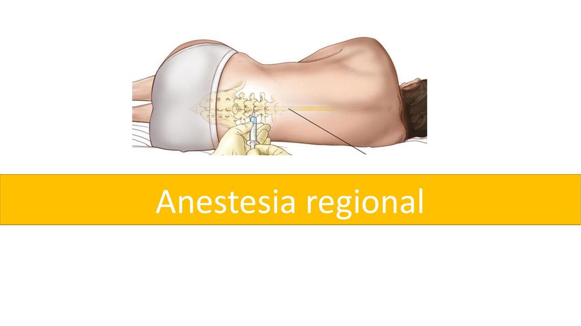 Anestesia regional