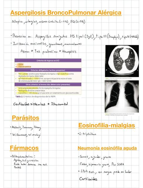 Aspergilosis Bronco Pulmonar Alérgica
