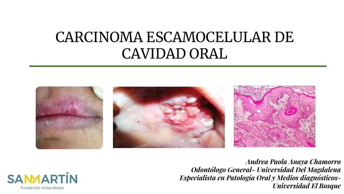 Carcinoma escamo celular de cavidad oral 