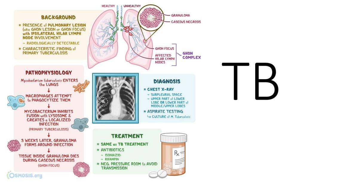 Tuberculosis 