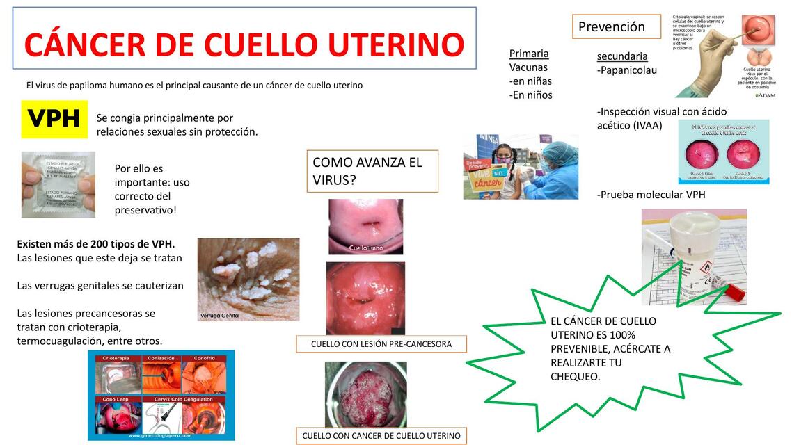 Cáncer de cuello uterino 