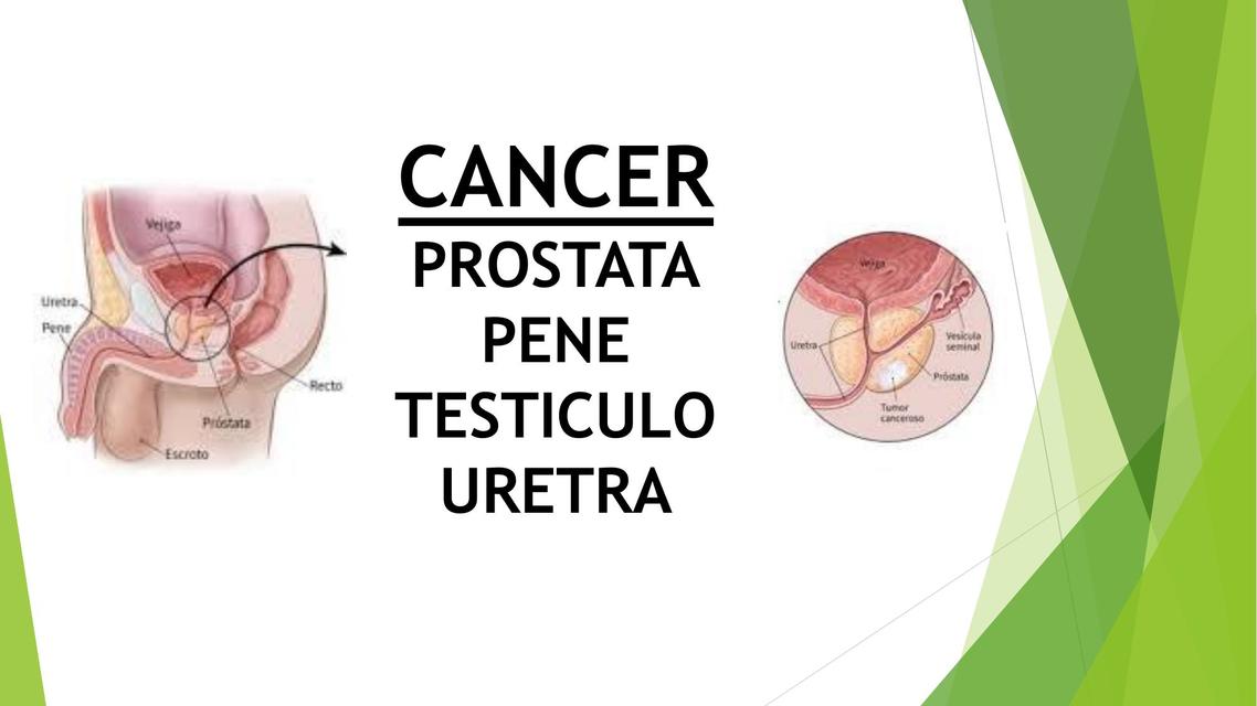 CANCER de prostata uretra testiculo