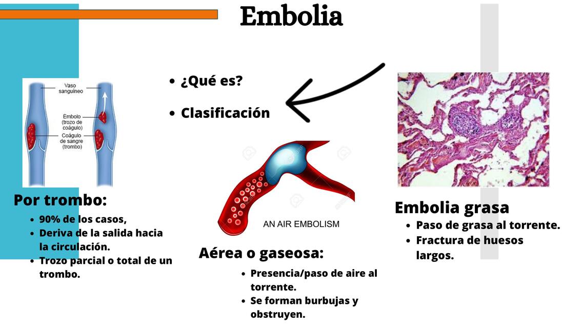 Embolia 