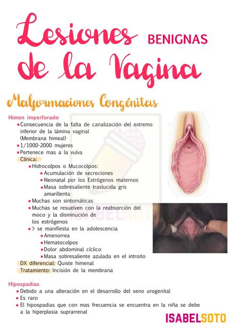 Lesiones benignas de la vagina 