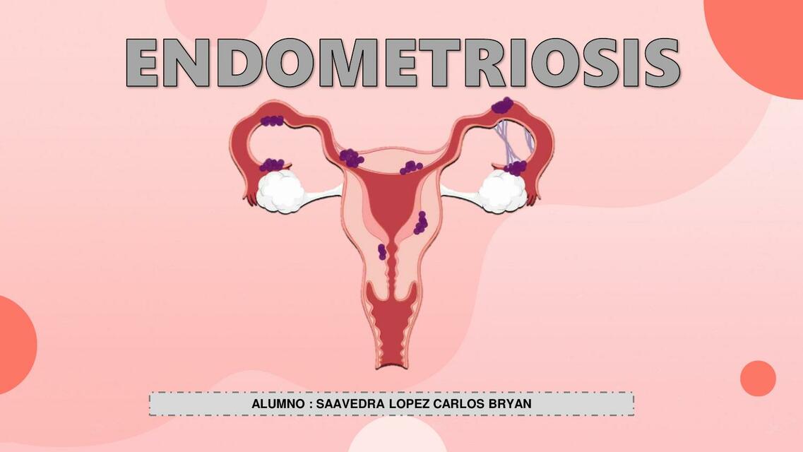 Endometriosis 