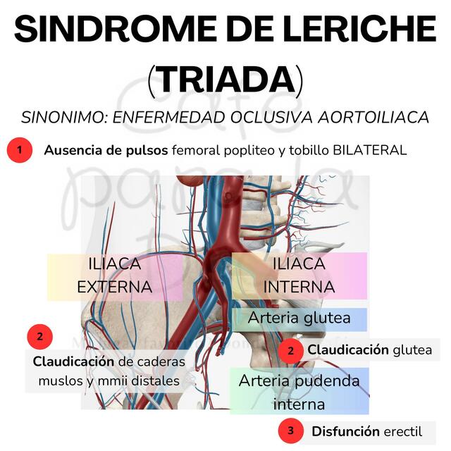 SINDROME DE LERICHE TRIADA Dra. Baltodano uDocz