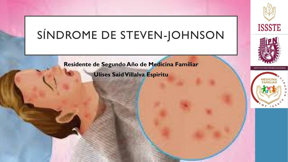 Síndrome de Steven Johnson