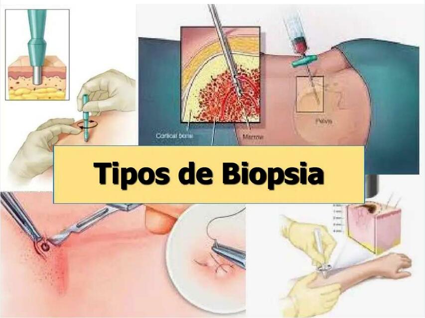 Tipos  biopsias compress