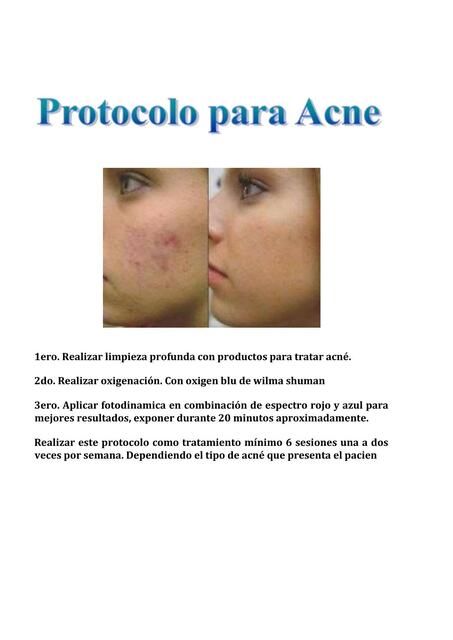 Protocolo para acne 