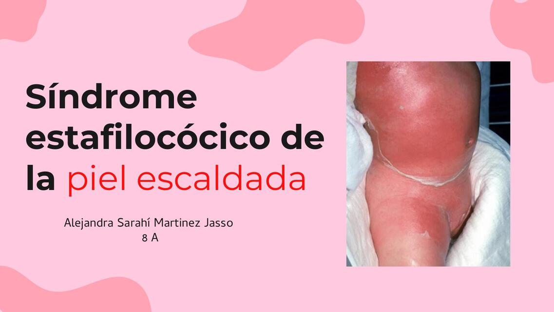 Síndrome de la piel escaldada | Malteada 2002 | uDocz