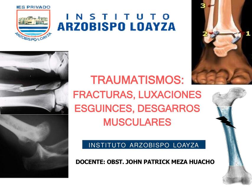 Traumatismos: Fracturas, Luxaciones, Esguinces, Desgarros Musculares 