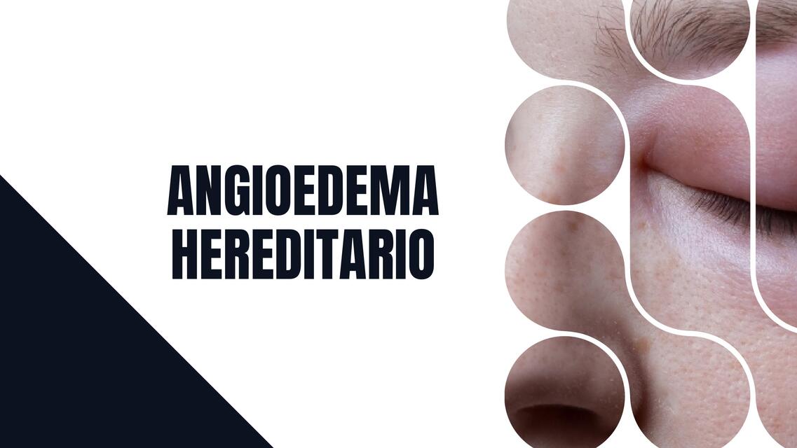 Angioedema hereditario 