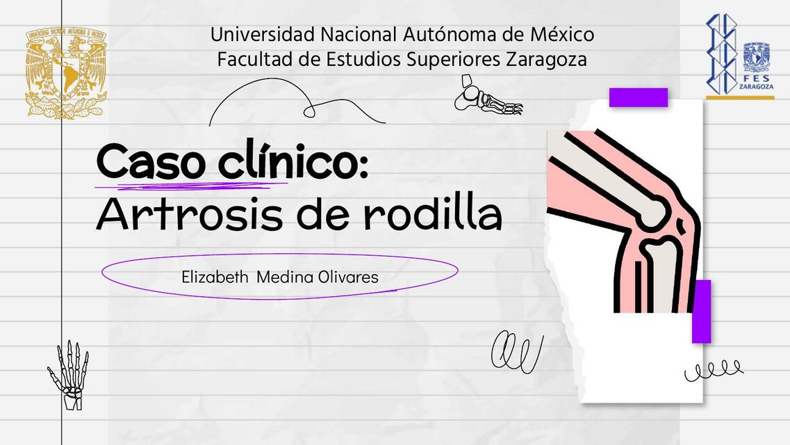 Caso clínico artrosis de rodilla