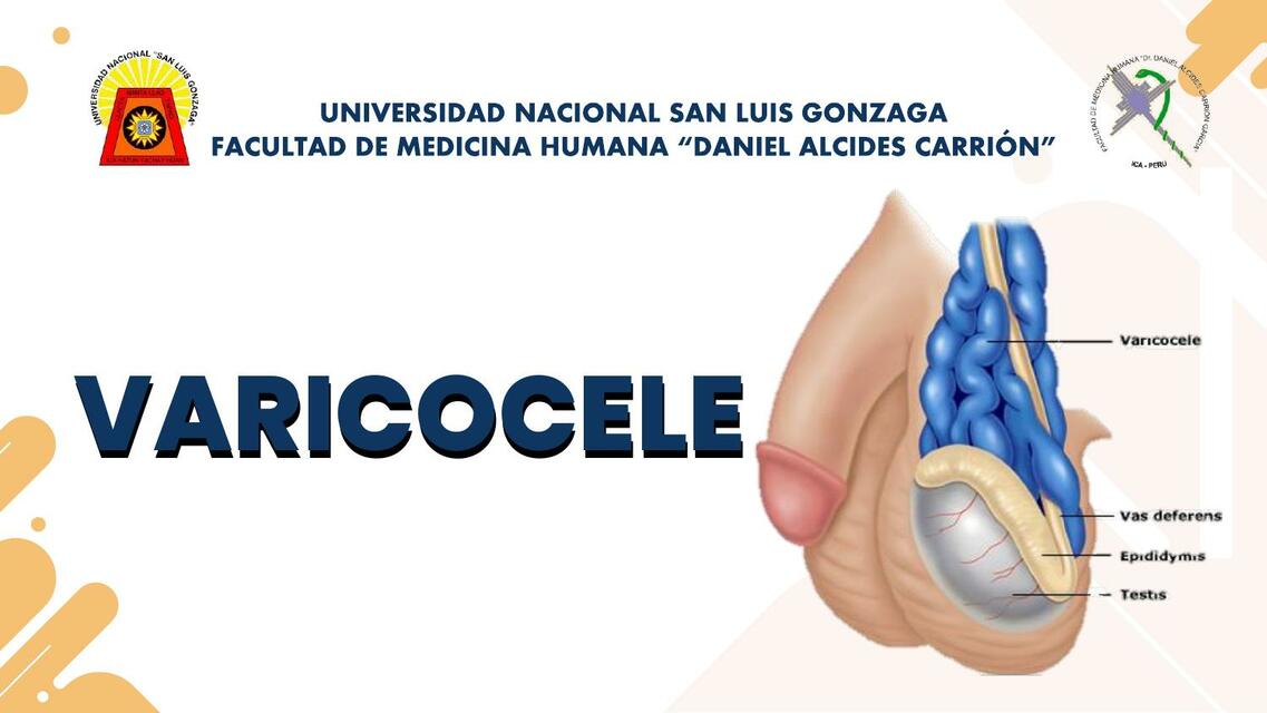 Varicocele 