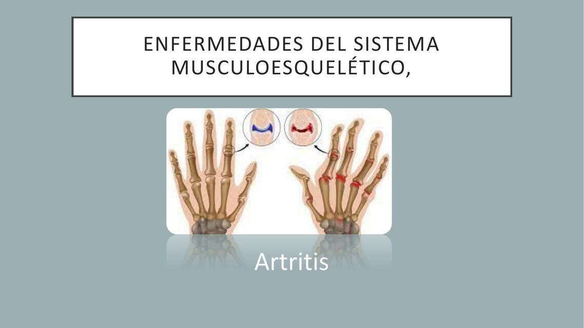 Enfermedades del Sistema Musculoesquelético 