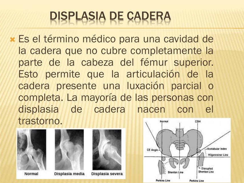 Displasia de Cadera 