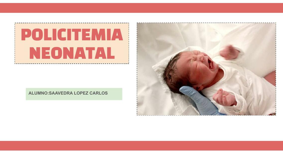 Policitemia neonatal