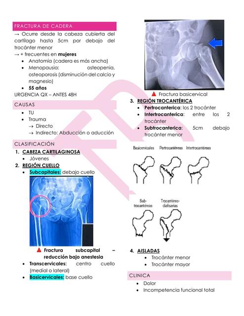 Fractura de Cadera 