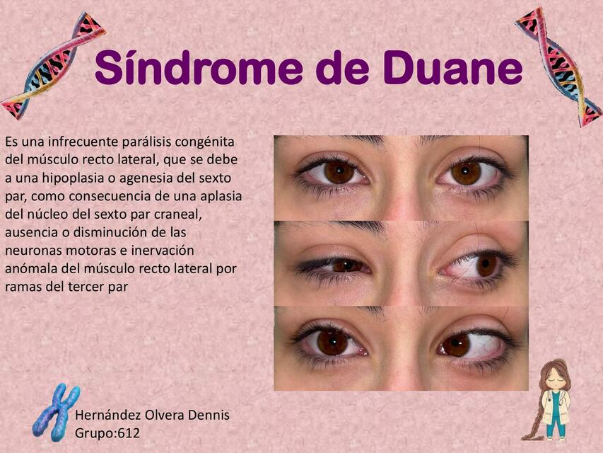 Síndrome de Duane