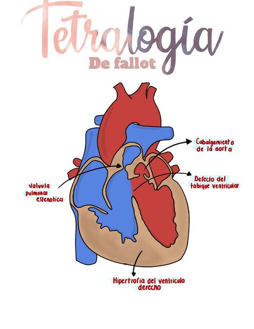 Tetralogía de Fallot