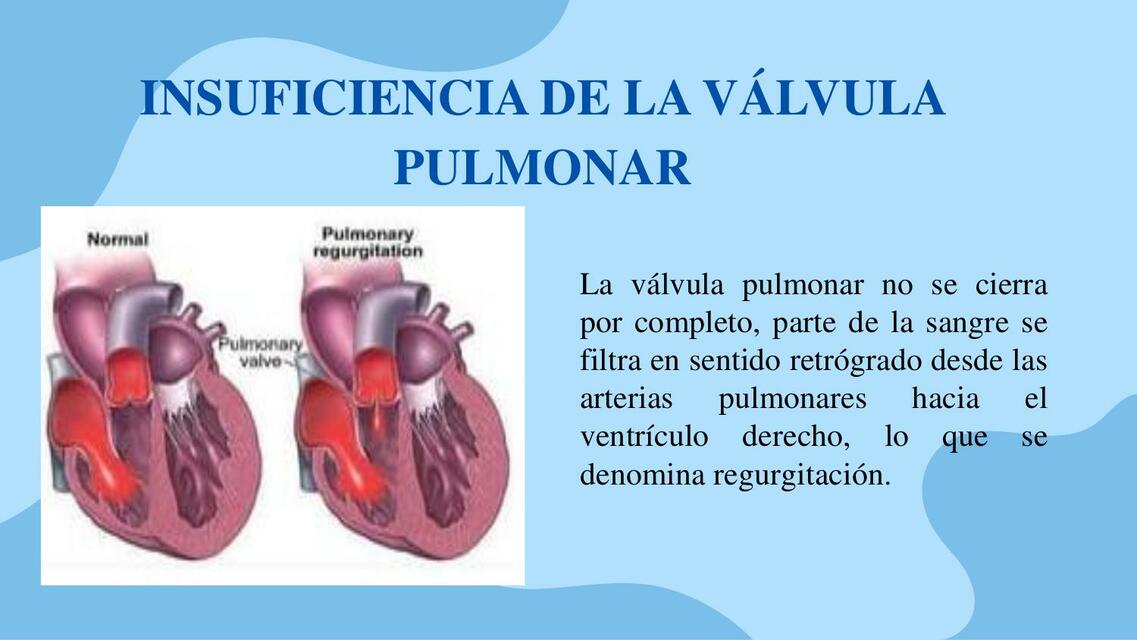 Valvulopatia pulmonar