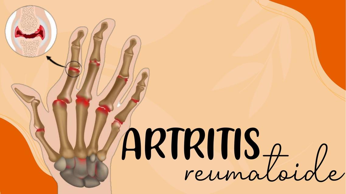 Artritis Reumatoide - Reumatología