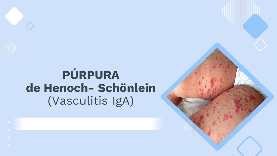 Vasculitis