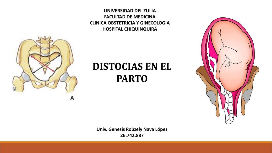 Distocias en el parto | Genesis Nava | uDocz