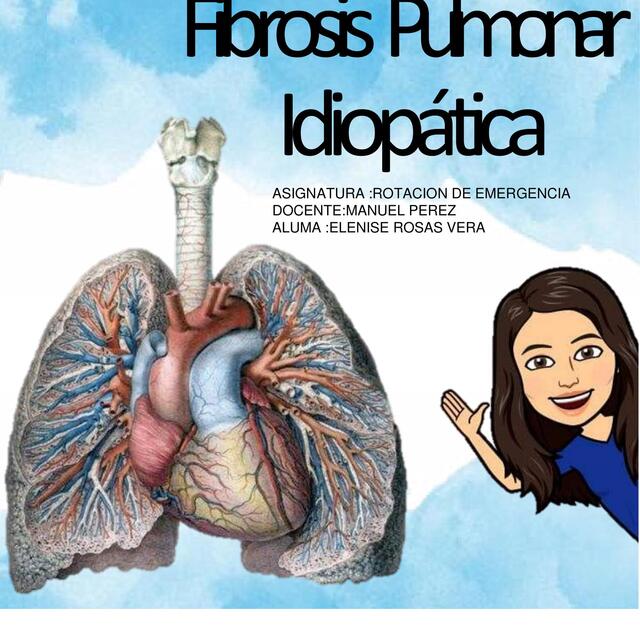 Fibrosis pulmonar idiopática  