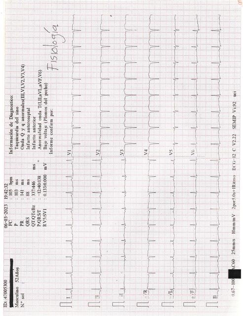 ECG 