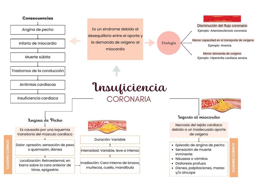 Insuficiencia Coronaria