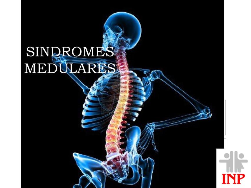 Sindrome medular