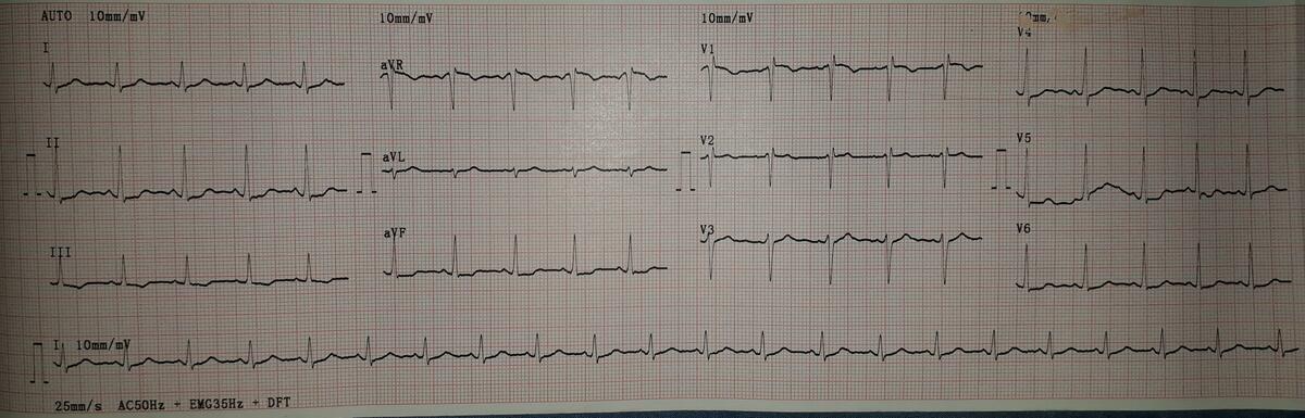 ECG 