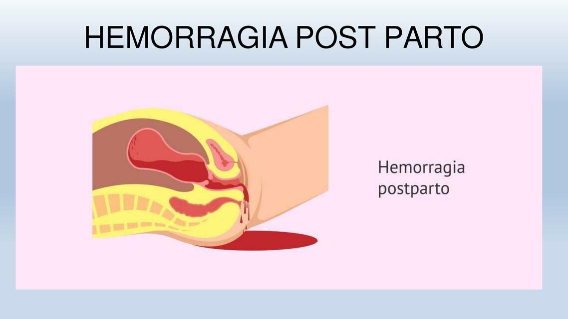 Hemorragia post parto