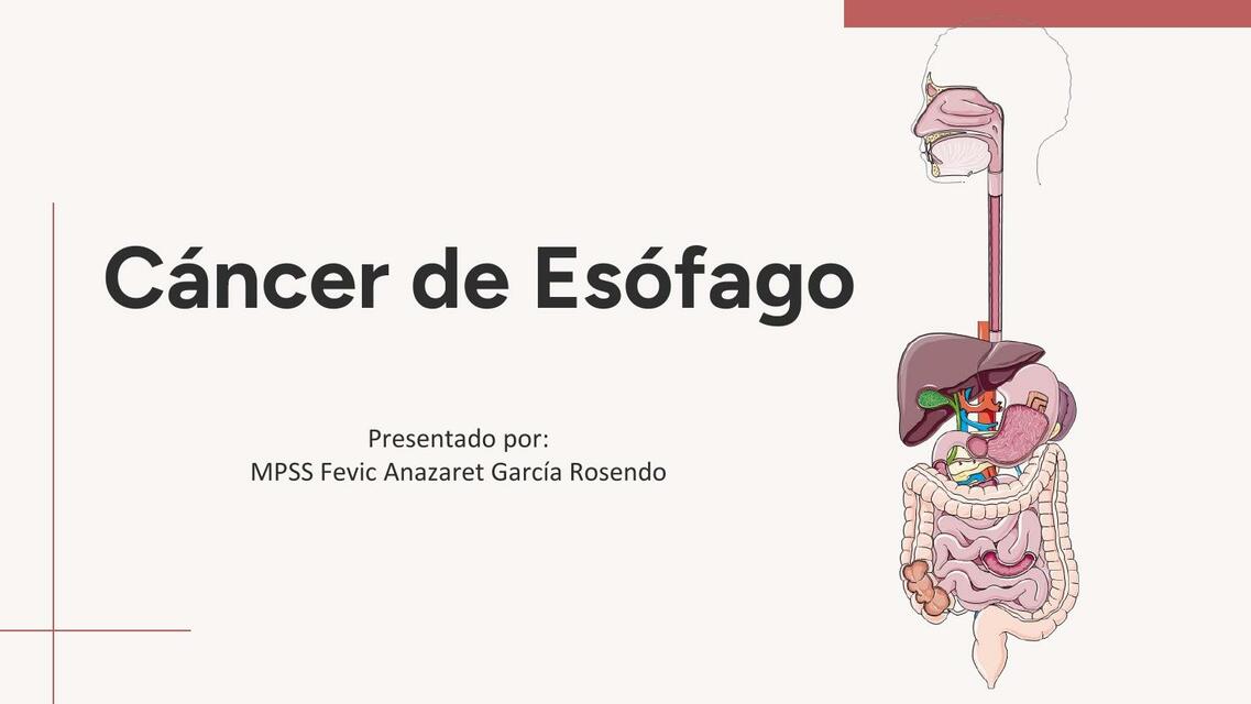 Cancer de Esófago